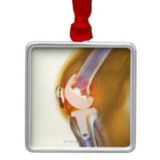 Knee replacement. Coloured X ray of a total knee Christmas Tree Ornaments