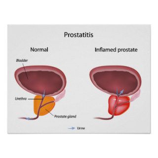 Prostatitis prostate inflammation Poster