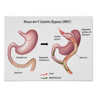 Roux en Y Gastric Bypass surgery poster
